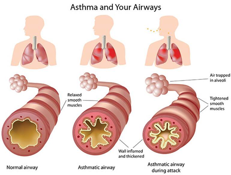 5.3 Diseases of the Respiratory System – Nursing Pharmacology