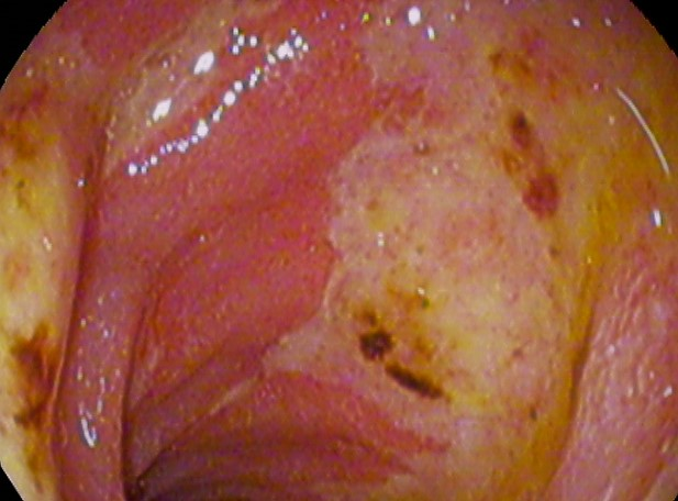 Photo of peptic ulcer disease