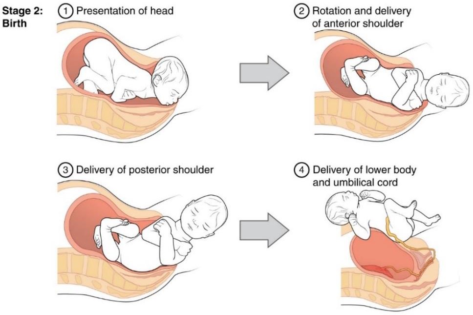 Full dilation and expulsion of the newborn. Step 1 shows the presentation of the head. Step 2 shows the rotation and delivery of anterior shoulder. Step 3 shows the delivery of posterior shoulder. Step 4 shows the delivery of the lower body and the umbilical cord.