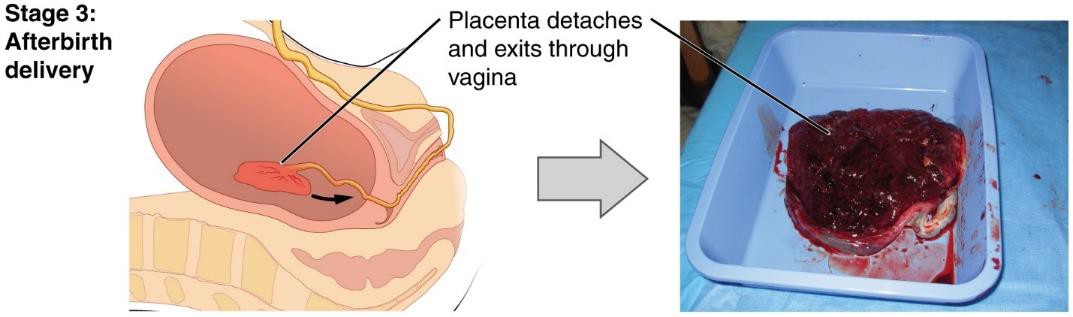 Delivery of the placenta and associated fetal membranes