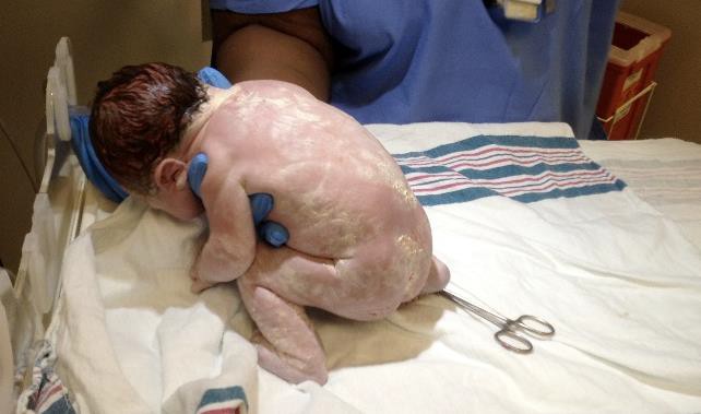 A newborn baby covered in vernix.