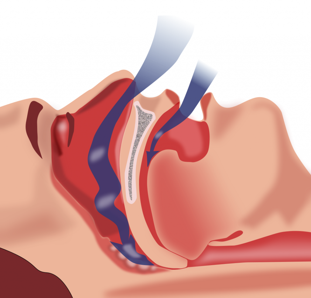 Illustration showing tissue placement in obstructive sleep apnea
