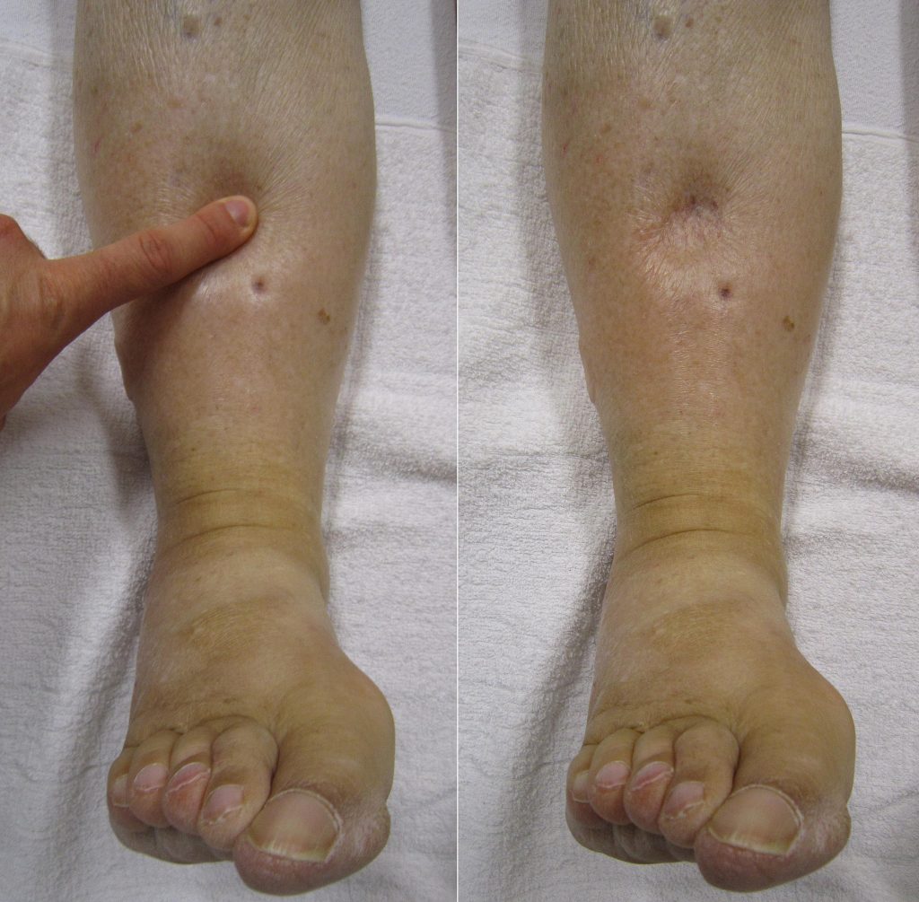 Photo showing pitting edema on lower legs