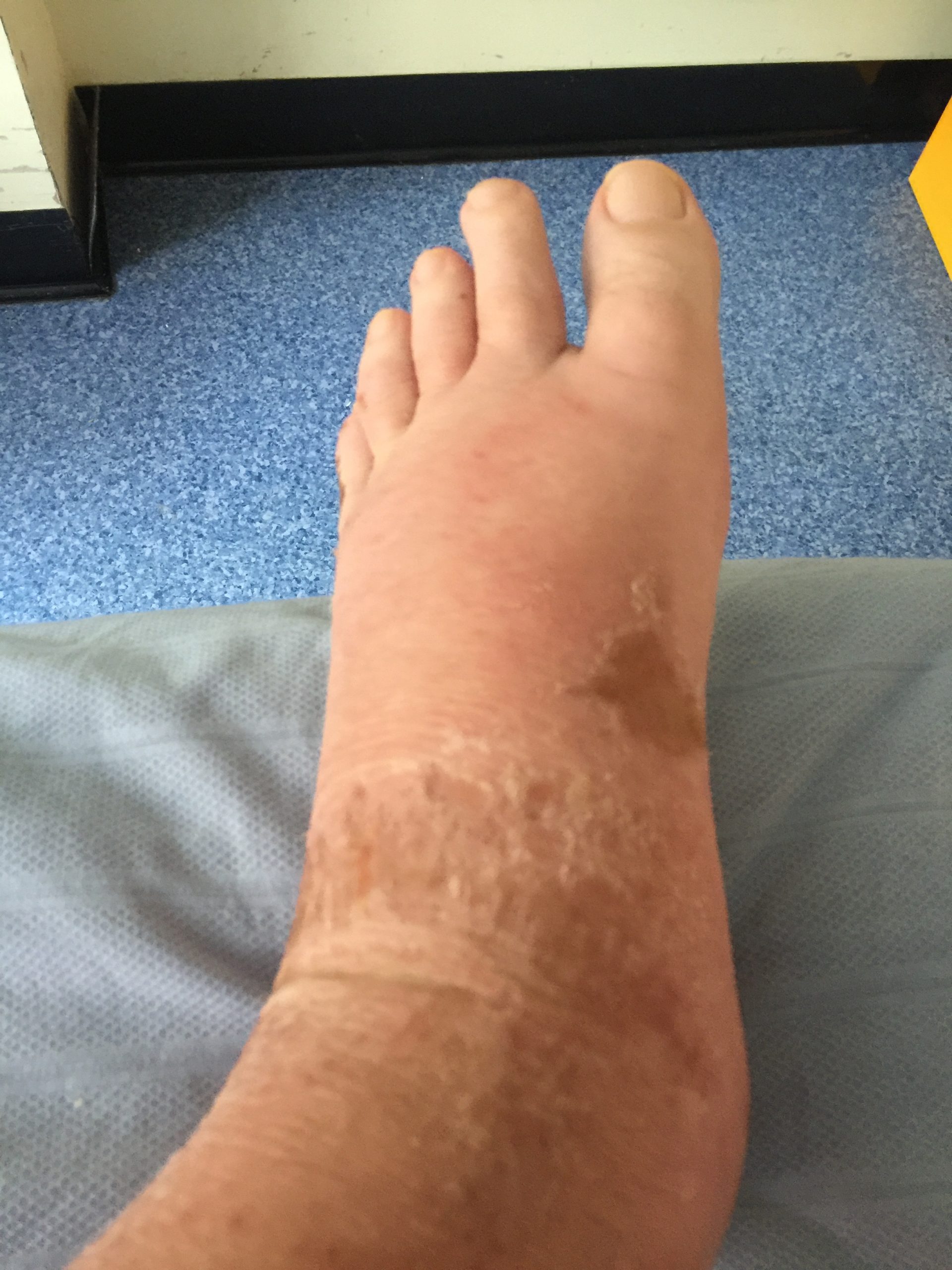 Photo of swollen foot