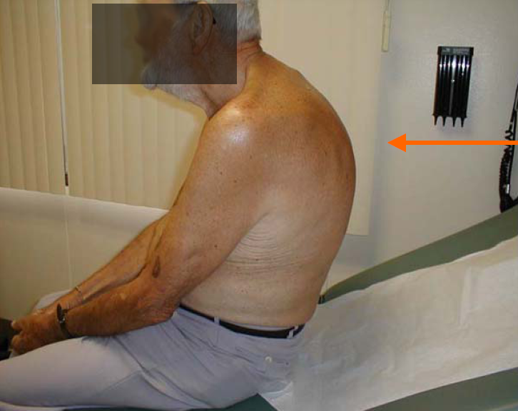 Photo of man with posturalkyphosis
