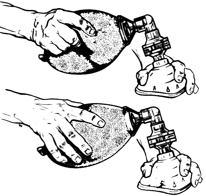 Illustration showing operation of a bag valve mask