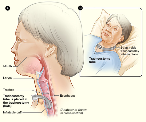 Illustration showing patient with tracheostomy tube from two angles