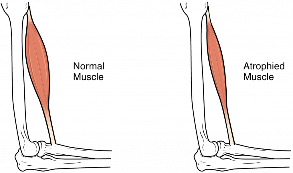 Illustration showing a normal and an atrophied muscle
