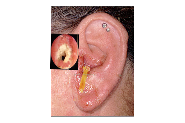 Photo showing ear infected with otitis externa, or swimmer's ear
