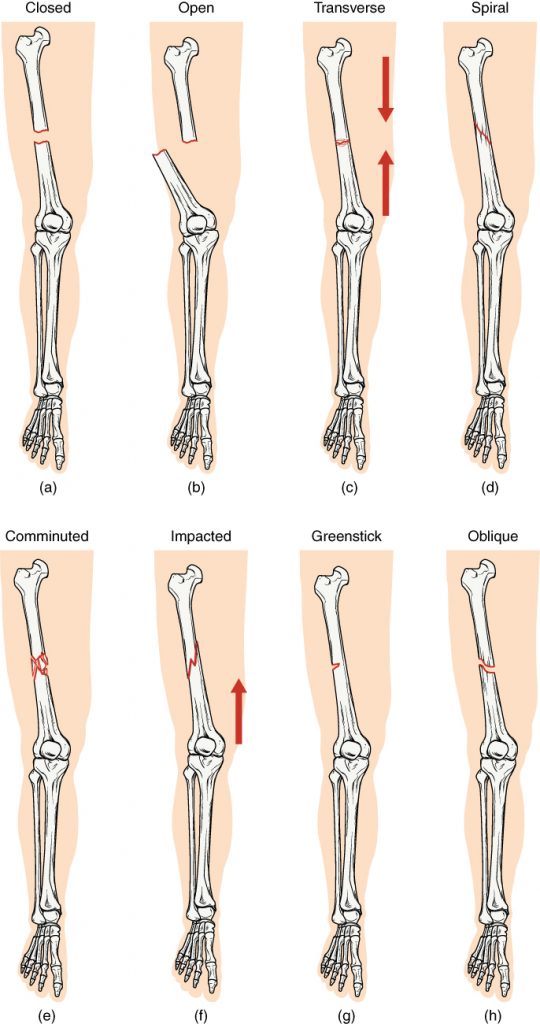 Illustrations showing eight different types of bone fractures