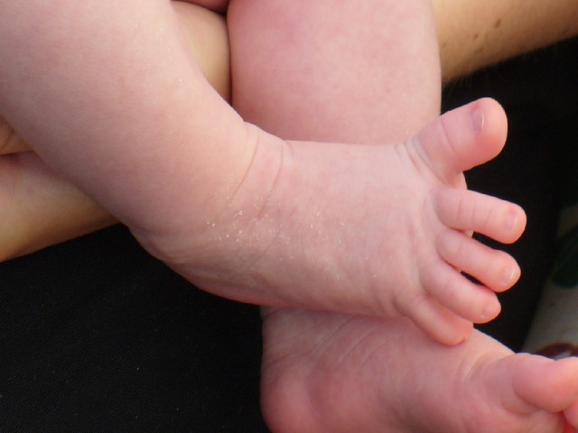 Photo showing closeup of an infant's splayed toes