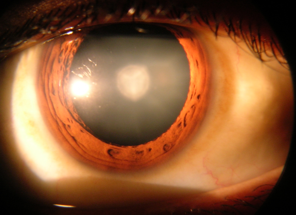 Photo showing closeup of eye with cataract