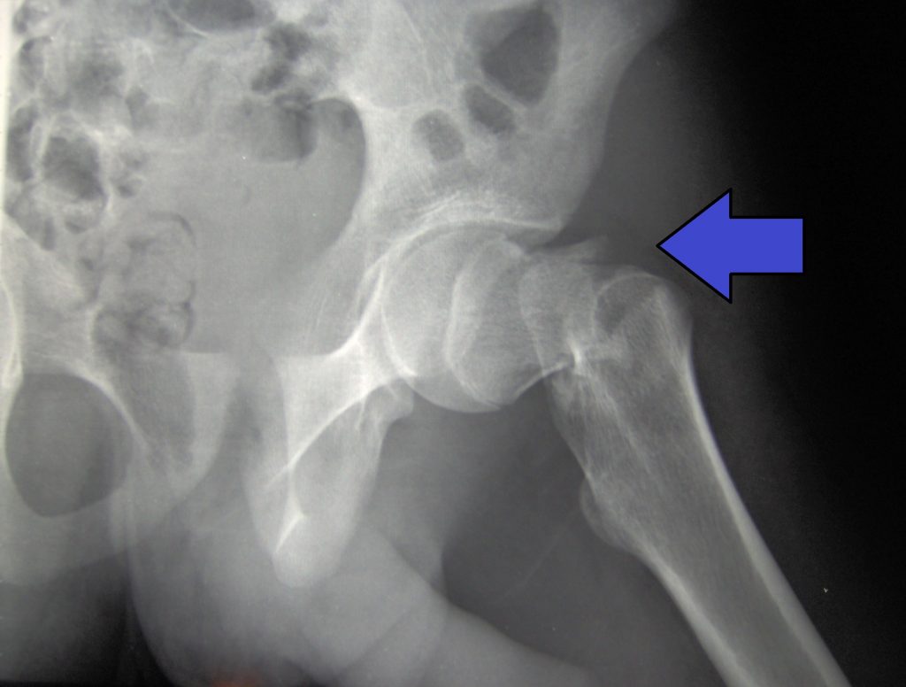 Xray image showing an arrow pointing at hip fracture
