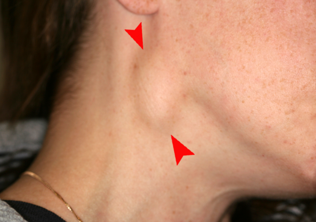 Photo of enlarged lymph node on a person's neck, with arrows to help identify swollen spot