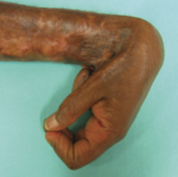 Photo of contracture on a person's wrist and hand