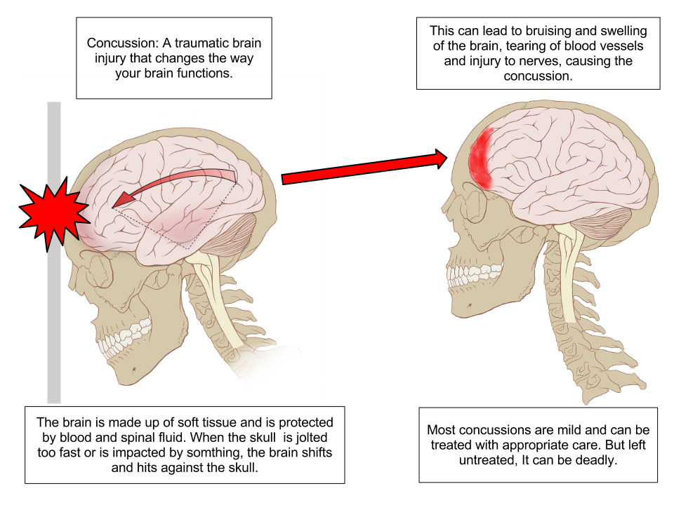Illustration showing effects of concussion with labels