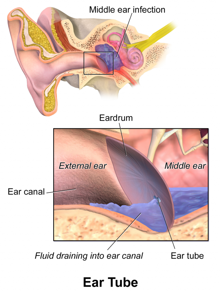 Illustration showing middle ear infection and a tympanostomy tube in place to alleviate symptoms.