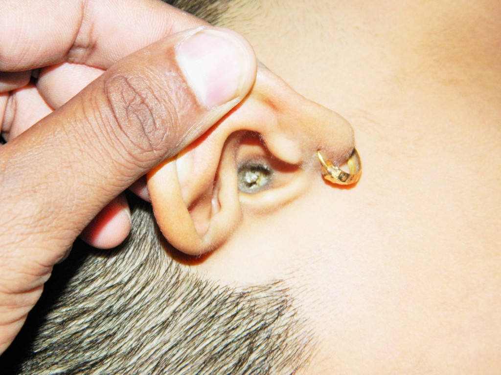 Photo showing an ear canal that is plugged with cerumen