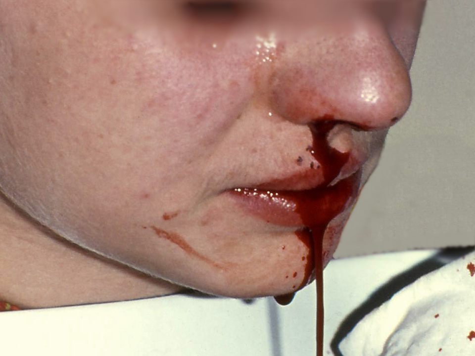Photo of person experiencing severe nosebleed