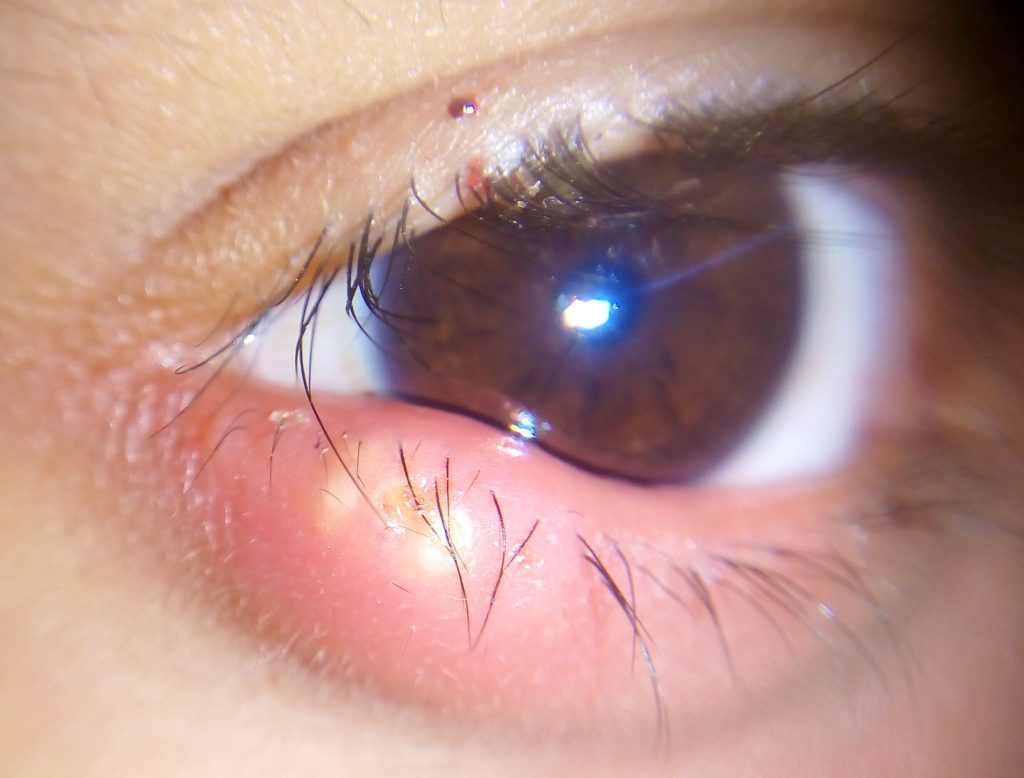 Photo showing closeup of eye with Stye on lower lid