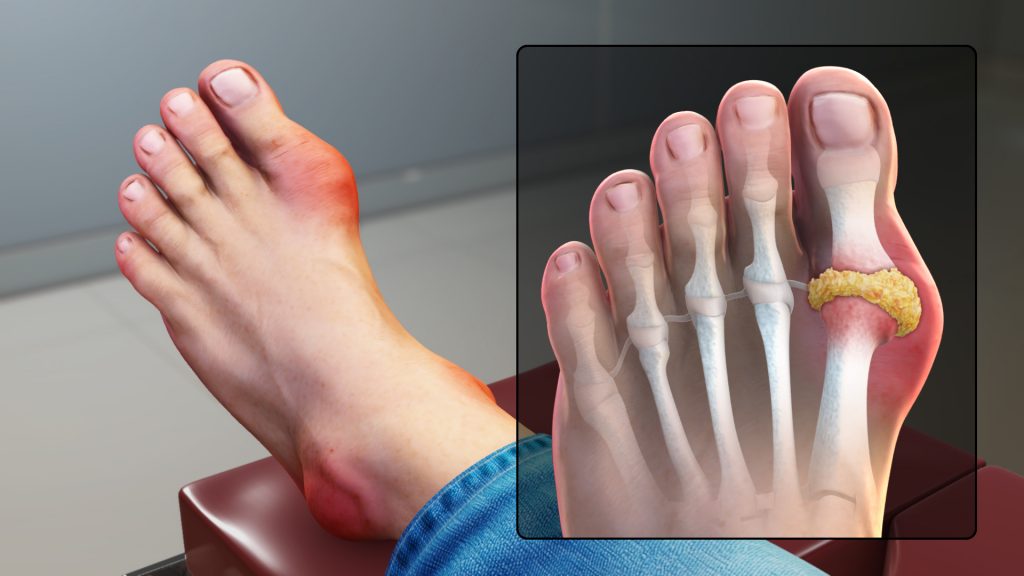 Image showing a foot with gout