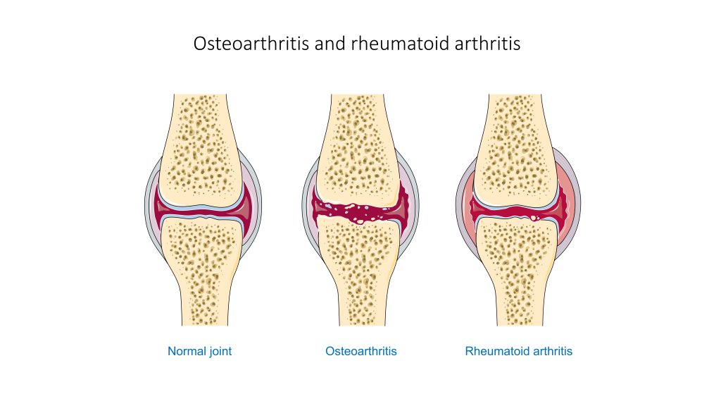 Illustration showing normal, osteoarthritis, and rheumatoid joints