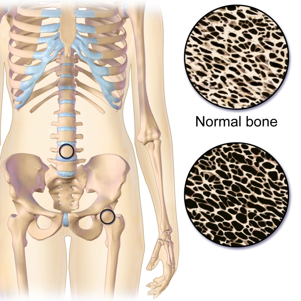 Illustration with closeups, showing osteoporosis versus normal bone density