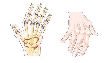 13.3 Common Musculoskeletal Conditions – Nursing Skills – 2e