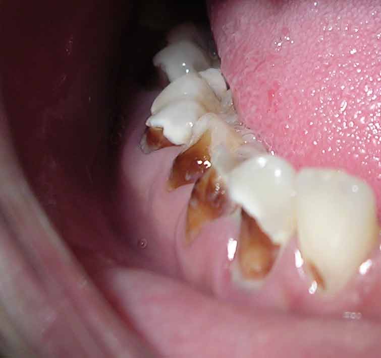 Photo showing close up of decay on teeth due to methamphetamine use