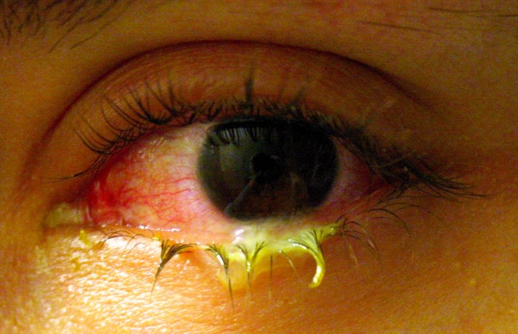 Photo showing closeup of eye infected with conjunctivitis