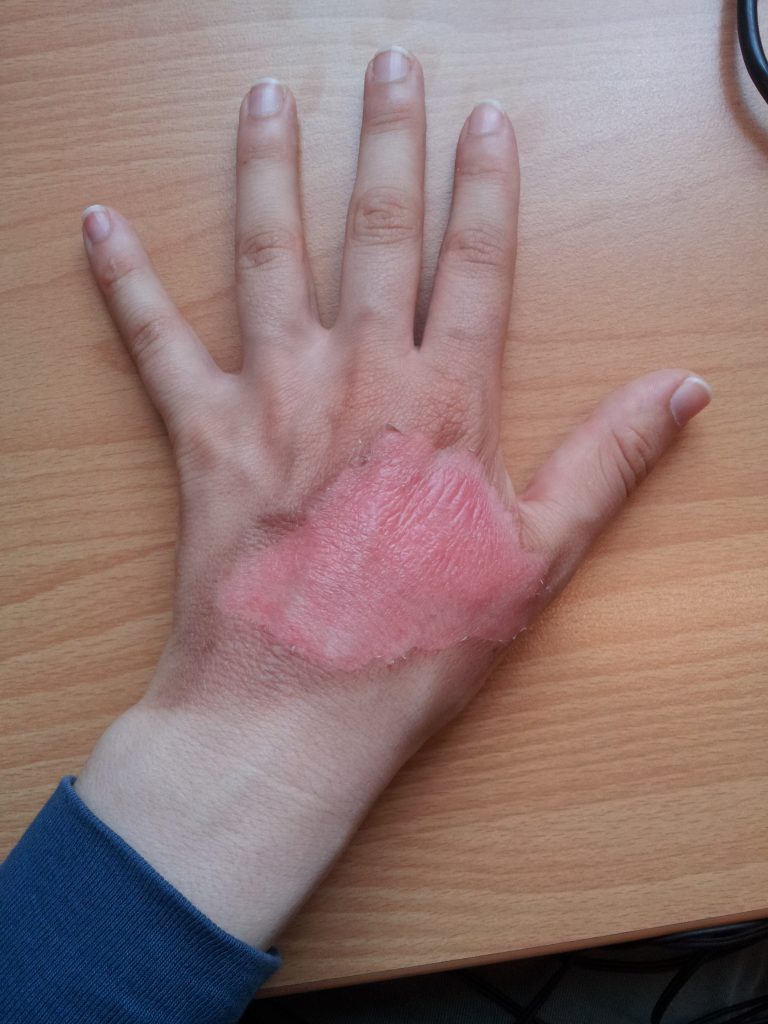 Photo showing hand with healing second degree burn