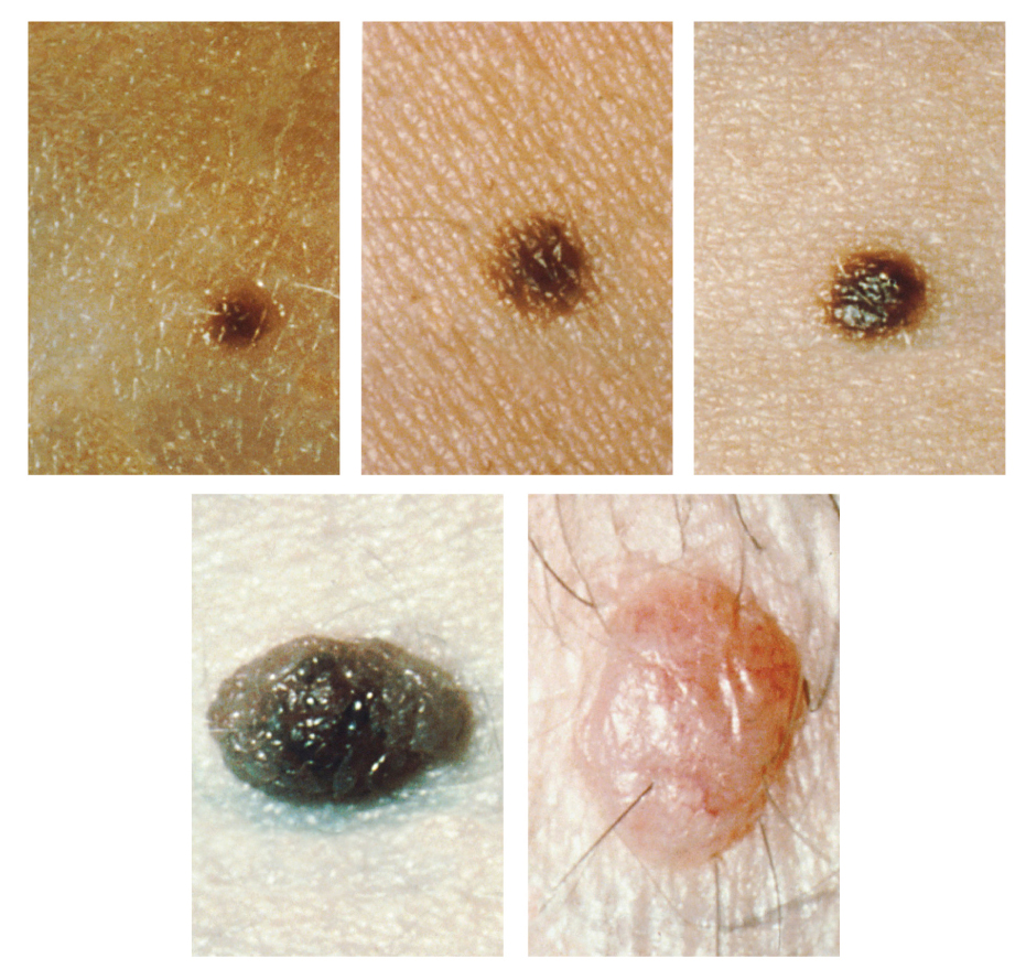 Photo showing several images of moles on skin