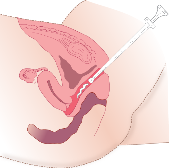 Illustration showing administration of vaginal medication