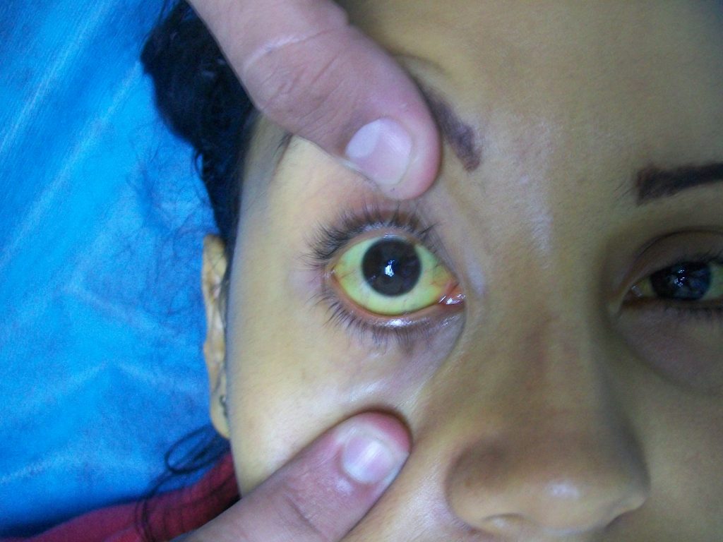 Photo showing yellowed sclera of eye due to jaundice
