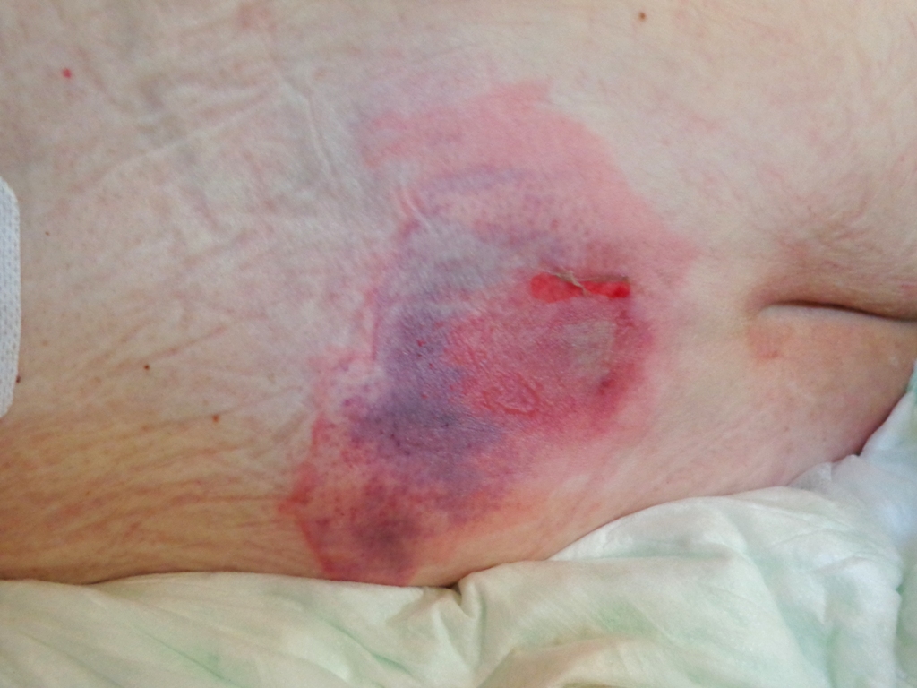 Photo showing closeup of a pressure ulcer on a patient's back