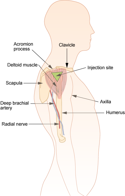 intradermal injection sites