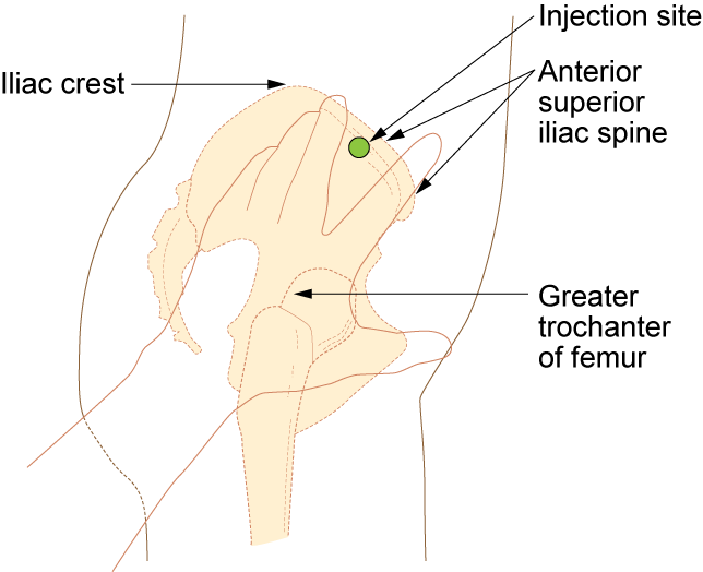 Illustration showing how to locate the ventrogluteal site