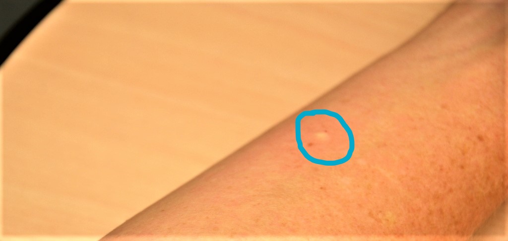 Photo showing a bleb on an arm, indicated by a circled area