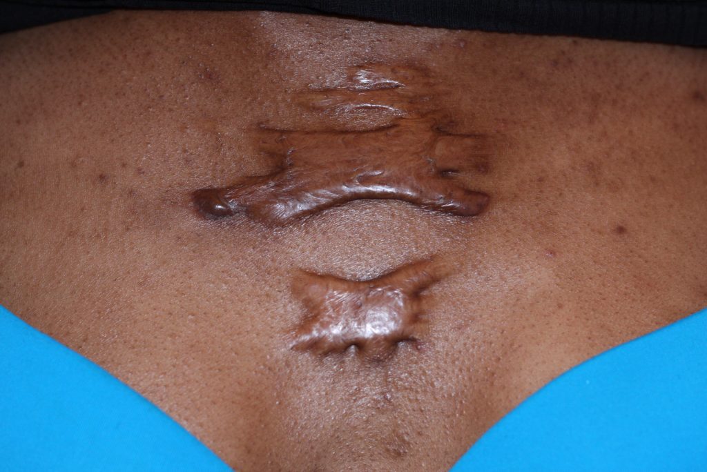 Photo of a large keloid on a person's chest area