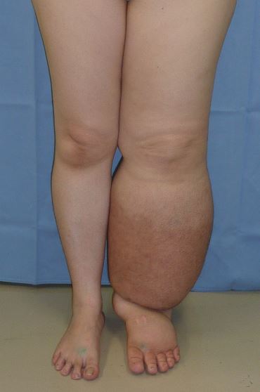 Photo showing lymphedema in left leg of patient