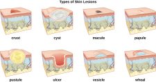 14.2 Basic Integumentary Concepts – Nursing Skills – 2e