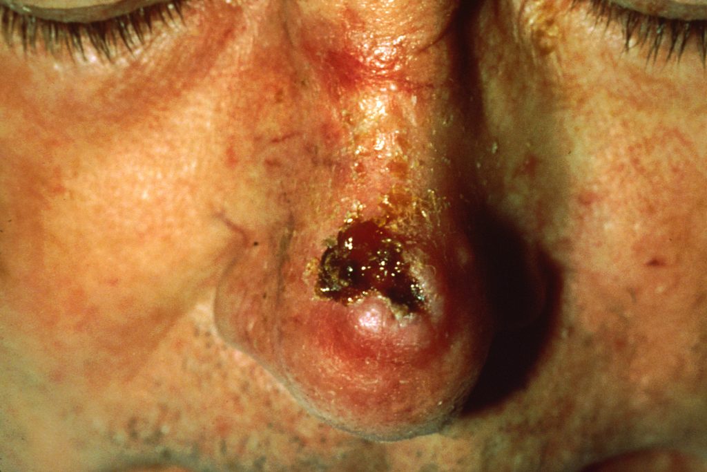 Photo showing damage from squamous cell carcinoma on a person's nose
