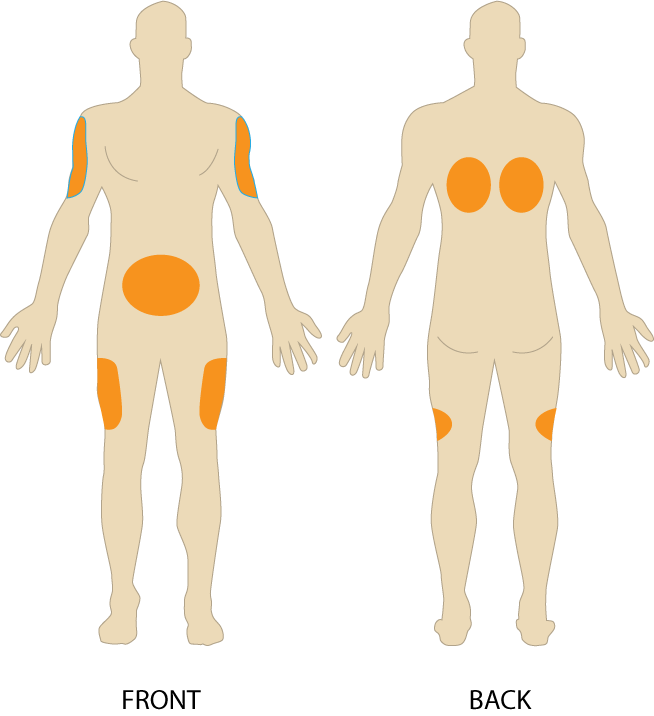 subcutaneous injection sites for injections