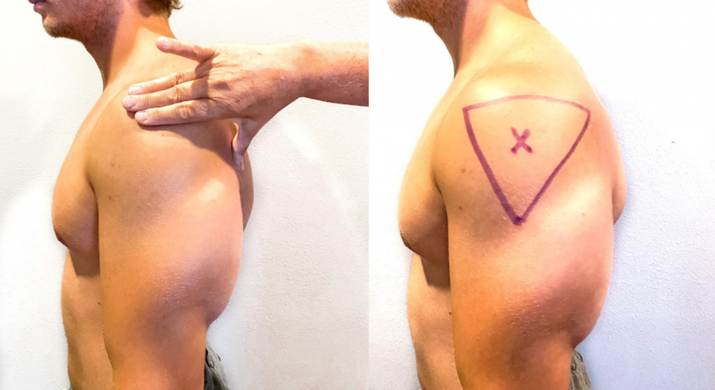 Photo showing the location of the deltoid injection site