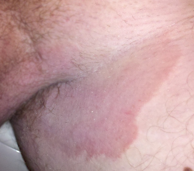 Photo showing fungal infection in the groin of a male