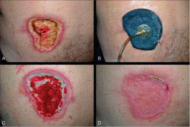 Photo showing progression of healing with a wound vac in four images