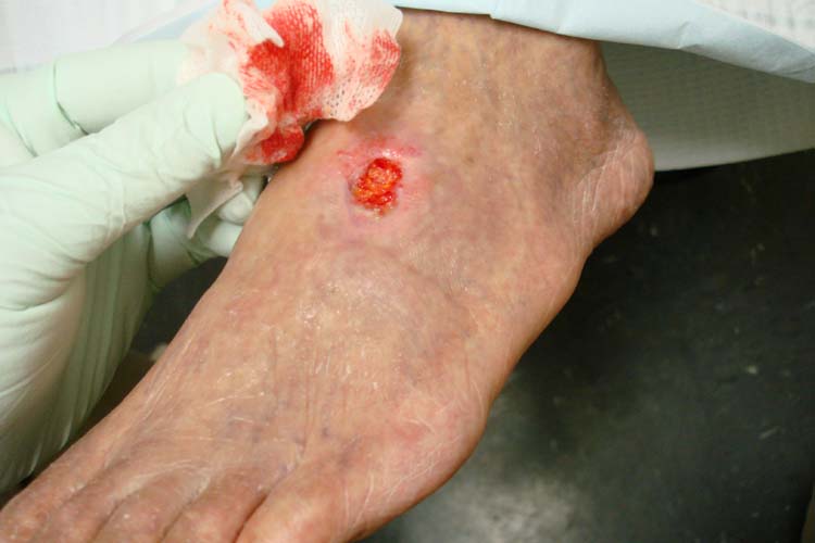Photo showing arterial ulcer on top of a foot