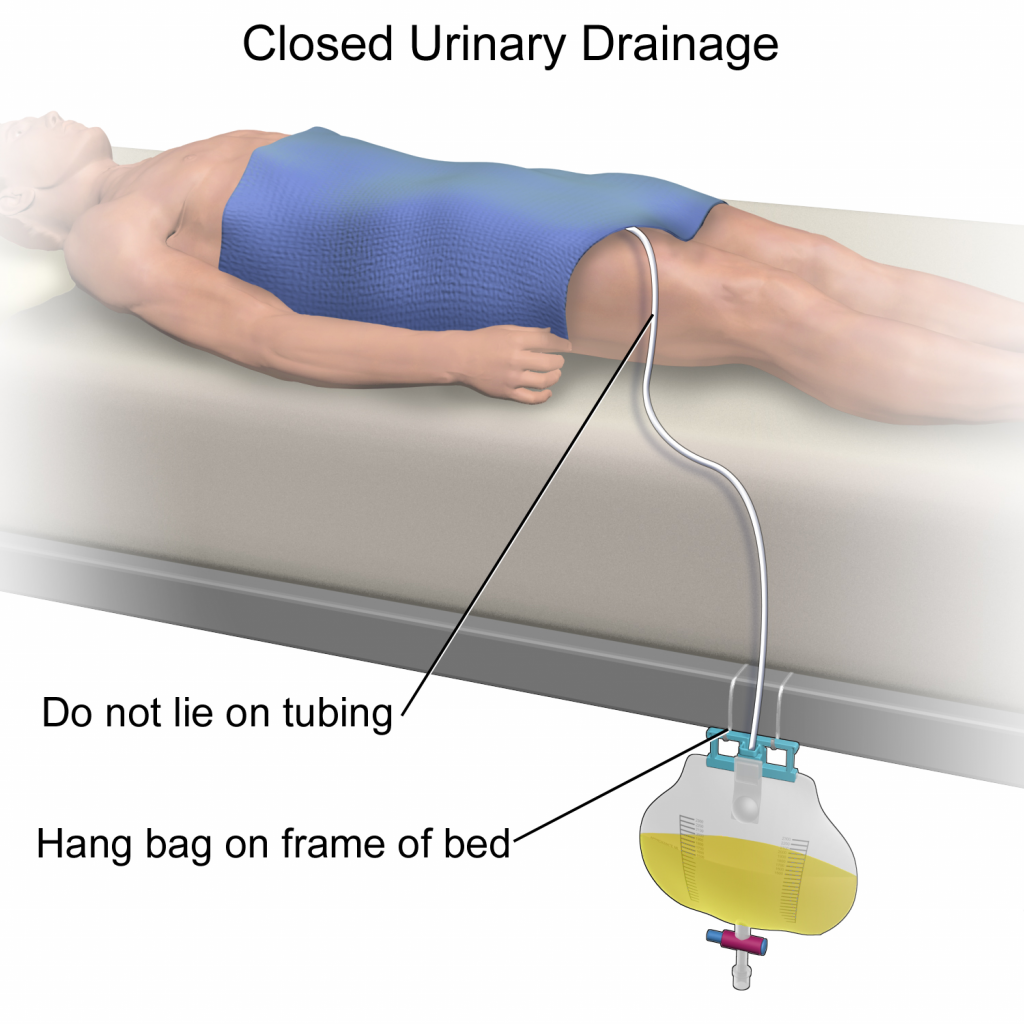 Illustration showing placement of urine collection bag, with labels