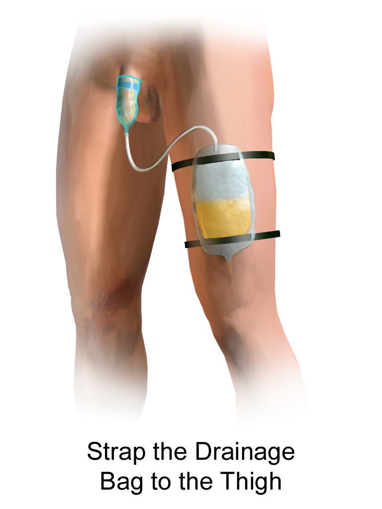 Illustration showing condom catheter attached to leg bag on male patient