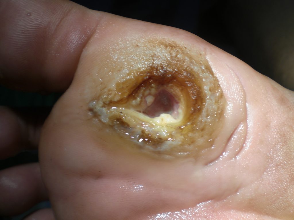 Photo showing closeup of diabetic ulcer on bottom of patient's foot